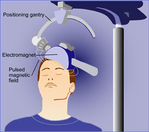 Is Magnetic Pulse Treatment An Answer For People Suffering From Drug-Resistant Depression?